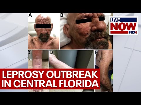 Leprosy in Florida: health officials consider it an ‘endemic’ | LiveNOW from FOX